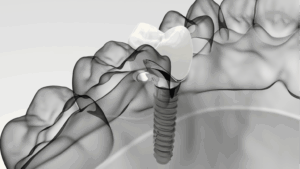 Dental Implants Sandbach Cheshire Consultations Announced for Private Patients at Crown Bank Dental